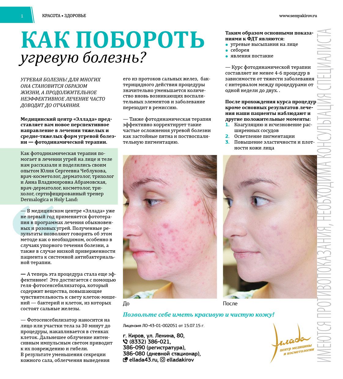 Как побороть угревую болезнь?